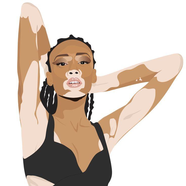 Vitiligo occurs when the melanin producing cells stops functioning thereby causing white patches on the skin. The white patches can affect any part of the body including the face.
vitiligo is more noticeable on people with dark skin and there's no cure for it. 